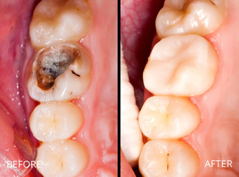 White filling to repair damaged tooth