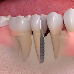 Dental implant